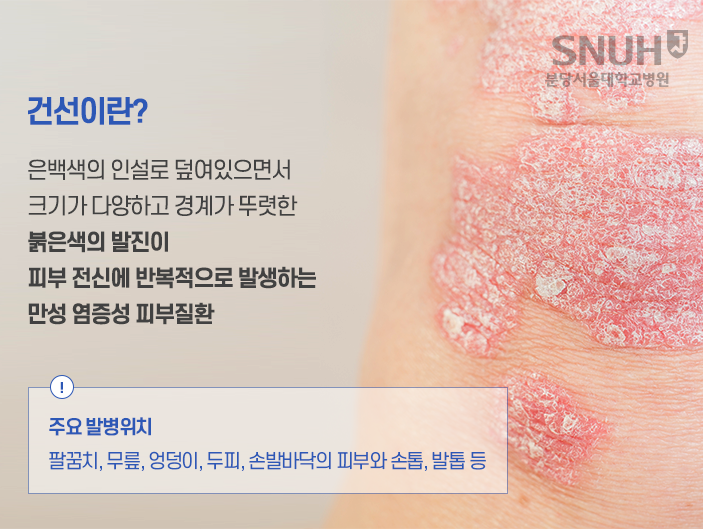 건선이란? 은백색의 인설로 덮여있으면서 크기가 다양하고 경계가 뚜렷한 붉은색의 발진이 피부 전신에 반복적으로 발생하는 만성 염증성 피부질환. 주요발병위치 - 팔꿈치, 무릎, 엉덩이, 두피, 손발바닥의 피부와 손톱, 발톱 등