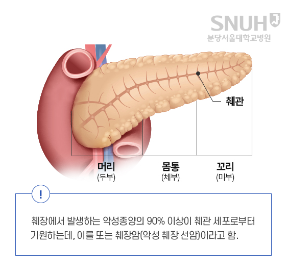 췌장의 구조 - 췌관, 머리(두부), 몸통(체부), 꼬리(미부). 취장에서 발생하는 악성종양의 90%이상이 췌관 세포로 부터 기원하는데, 이를 또한 췌장암(악성 췌장 선암)이라고 함.