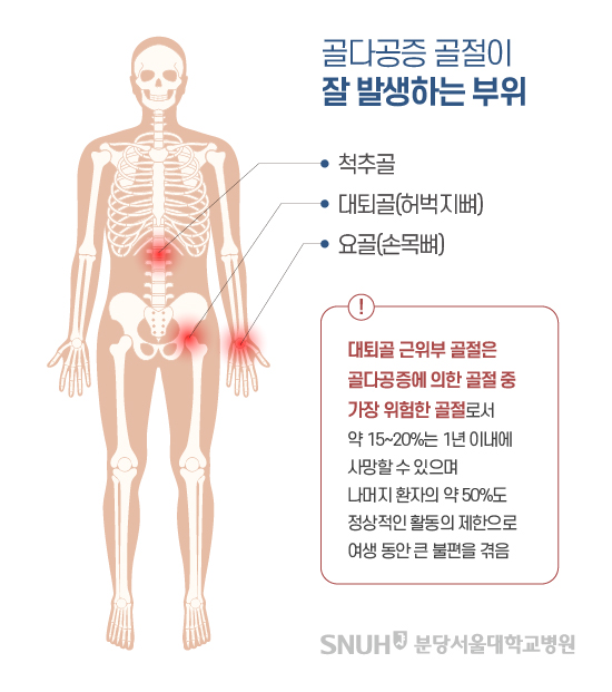 골다공증이 잘 발생하는 부위. 골다공증 골절이 잘 발생하는 부위: 척추골, 대퇴골(허벅지뼈), 요골(손목뼈), 대퇴골 근위부 골절은 골다공증에 의한 골정 중 가장 위험한 골절로서 약 15~20%는 1년 이내에 사망할 수 있으며 나머지 환자의 약 50%도 정상적인 활동의 제한으로 여생 동안 큰 불편을 격음