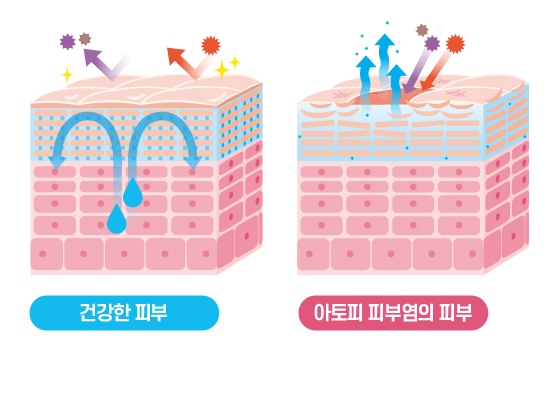 건강한 피부와 아토피 피부염의 비교