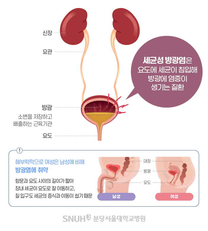 세균성 방광염은 요도에 세균이 침입해 방광에 염증이 생기는 질환. 해부학적으로 여성은 남성에 비해 방광염에 취약. 항문과 요도 사이의 길이 짧아. 장내 세균이 요도로 잘 이동하고, 질 입구도 세균의 증시과 이동이 쉽기 때문