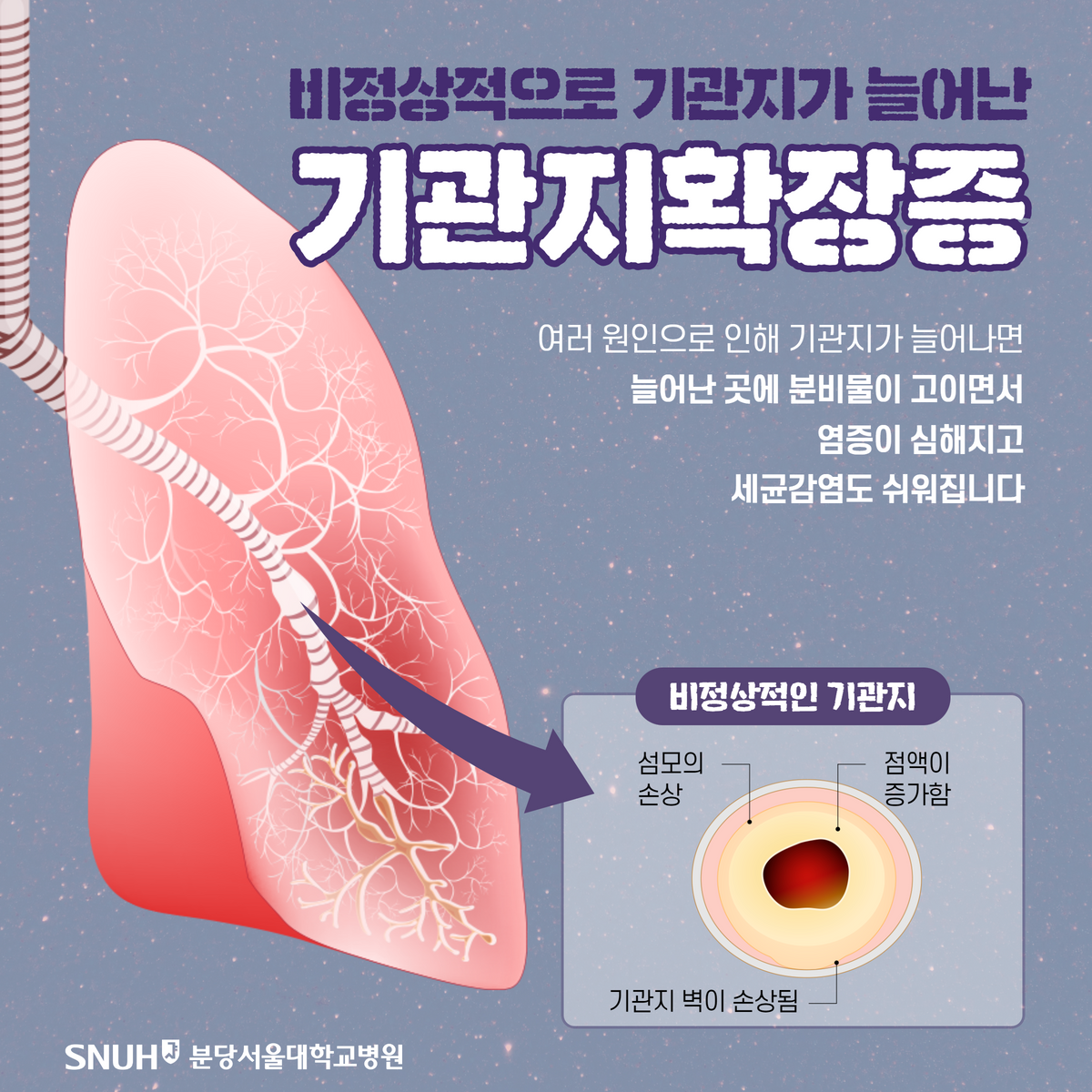 기관지 확장증 설명