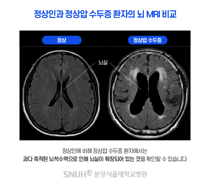 정상인과 정상압수두증 환자의 뇌 MRI 비교