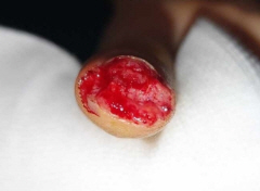 그림 1-1. 족지 피부 전이술을 이용한 수지첨부 재건 성형 