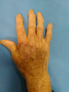 그림 3-2. 손등에 발생한 피부암 적출 및 유리피판을 이용한 재건 성형