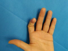 그림 1-2. 족지 피부 전이술을 이용한 수지첨부 재건 성형 