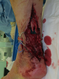 그림 2-1. 발목에서 아킬레스건 파열과 피부 결손에 대해 유리피판술을 이용한 동시 재건 성형