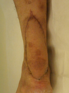 그림 2-2. 발목에서 아킬레스건 파열과 피부 결손에 대해 유리피판술을 이용한 동시 재건 성형