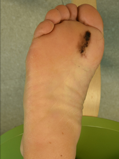 그림 4-1. 발바닥의 흑색종에 대해 암적출과 함께 유리피판술을 이용한 피부 재건 성형