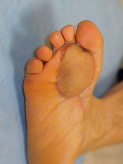 그림 4-2. 발바닥의 흑색종에 대해 암적출과 함께 유리피판술을 이용한 피부 재건 성형