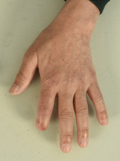 그림 2-1. 제2족지 전이술을 이용한 좌측 제2수지 재건 성형