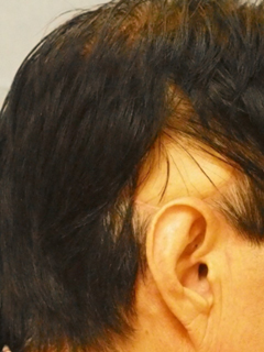 그림 1-2. 측두부에 발생한 편평상피세포암에 대해 암적출 후 유리피판술을 이용한 피부 재건