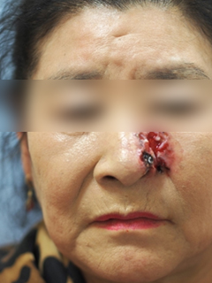 그림 2-1. 좌측 안면부에 발생한 기저세포암에 대해 암적출 후 유리피판술을 이용한 피부 재건