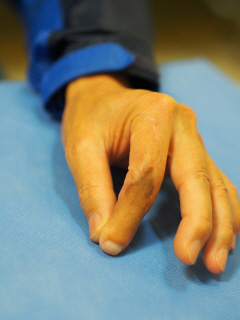 그림 2-2. 제2족지 전이술을 이용한 좌측 제2수지 재건 성형