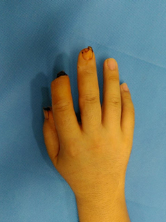 그림 3-1. 제2족지 전이술을 이용한 우측 제2수지 재건 성형