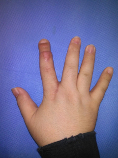 그림 3-2. 제2족지 전이술을 이용한 우측 제2수지 재건 성형