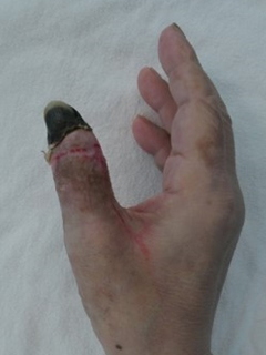 그림 4-1. 제1족지 전이술을 이용한 우측 제1수지 재건 성형