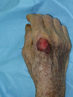 그림 3-1. 손등에 발생한 피부암 적출 및 유리피판을 이용한 재건 성형