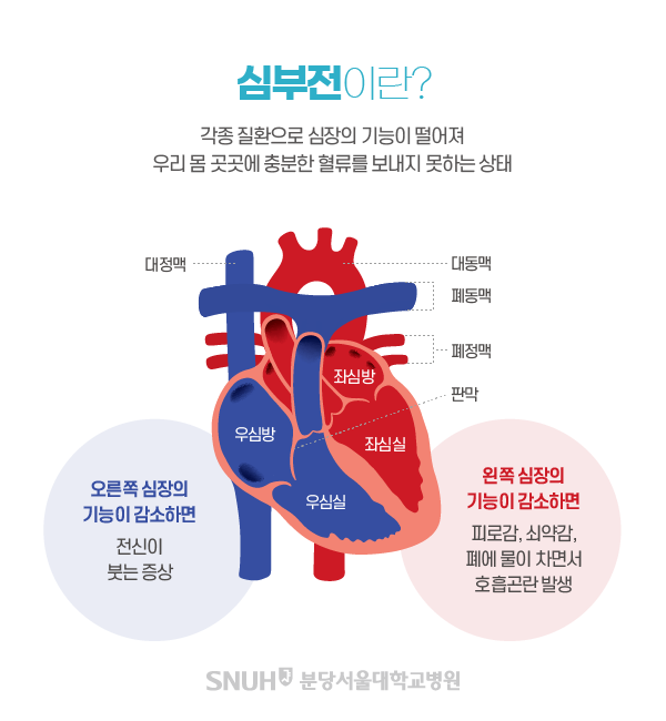 심부전이란?각종 질환으로 심장의 기능이 떨어져 우리 몸 곳곳에 충분한 혈류를 보내지 못한 상태.오른쪽 심장의 기능이 감소하면 전신이 붓는 증상.왼쪽 심장의 기능이 감소하면 피로감, 쇠약감, 폐에 물이 차면서 호흡곤란 발생