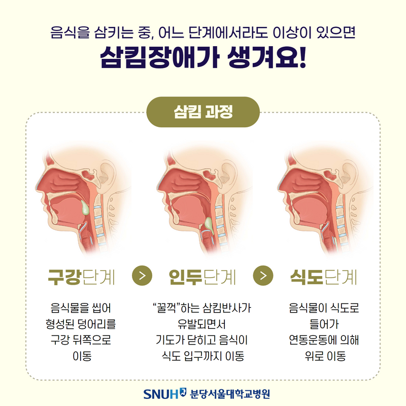 삼킴과정 일러스트: 음식을 삼키는 중 어느 단계에서라도 이상이 있으면 삼킬장애가생거요!.구강단계.음식물을씹어 형성된덩어리를 구강뒤쪽으로 이동.인두단계.‘꿀깍'하는 삼킴반사가 유발되면서 기도가 닫히고 음식이 식도입구까지 이동.식도단계.음식물이 식도로 들어가 연동운동에 의해 위로 이동