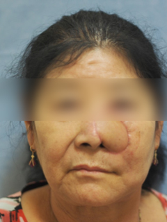 그림 2-2. 좌측 안면부에 발생한 기저세포암에 대해 암적출 후 유리피판술을 이용한 피부 재건