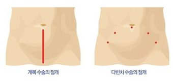 로봇수술의 장점2