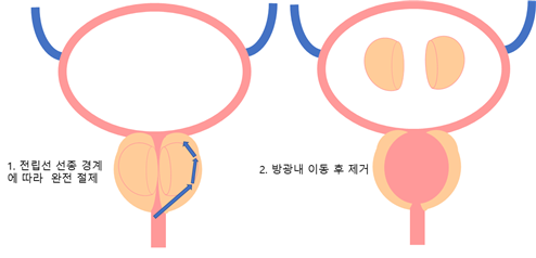 경요도전립선적출술 – 양극적 전극 (TUEB) 또는 레이저 (HoLEP)