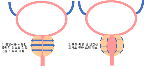 경요도전립선적출술 – 양극적 전극 (TUEB) 또는 레이저 (HoLEP)