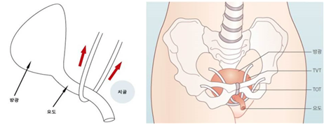 요실금의 수술적 치료