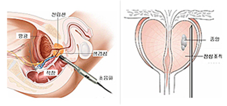 전립선 조직검사