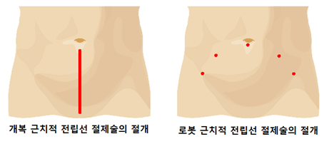 전립선절제술의 절개법