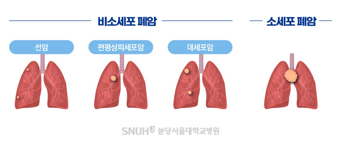 폐암의 종류 이미지: 비포세포 폐암 : 선암, 펀평상피세포암, 대세포암, 소세포 폐암