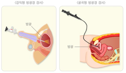 방광경 검사