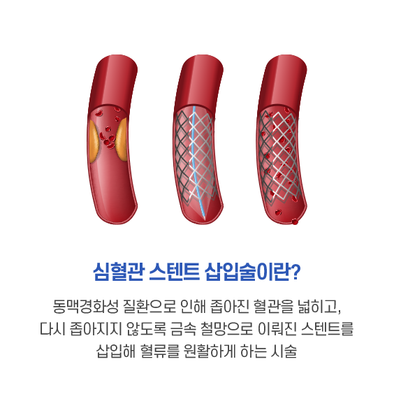 심혈관 스텐트 삽입술이란. 동맥경화성 질환으로 인해 좁아진 혈관을 넓히고, 다시 좁아지지 않도록 금속 철망으로 이뤄진 스텐트를 삽입해 혈류를 원활하게 하는 시술