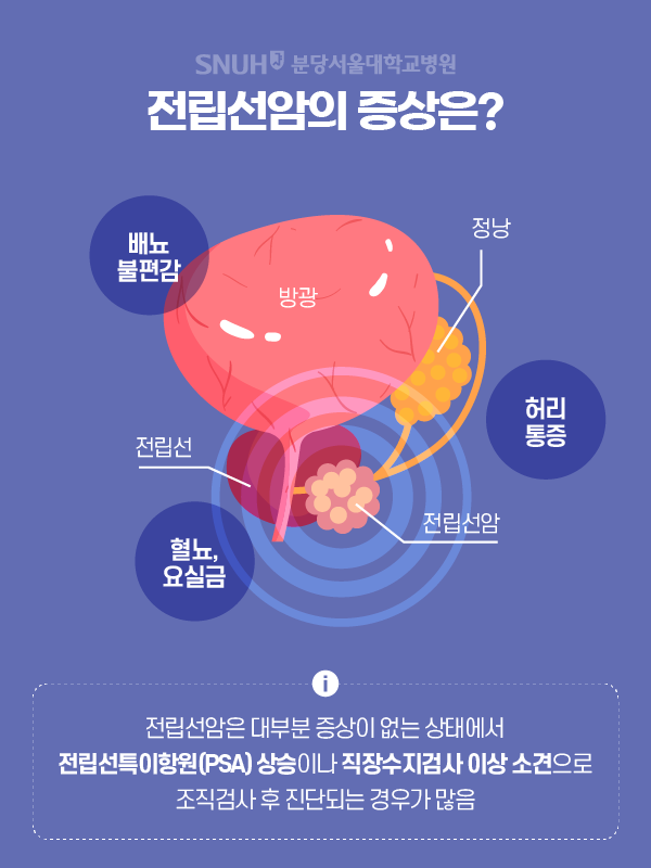 전립선암의 증상은? 정낭, 방광, ,전립선, 전립선암 - 배뇨불편감, 허리통증, 혈뇨, 요실금 / i 전립선암은 대부분 증상이 없는 상태에서 전립선특이항원(PSA) 상승이나 직장수지검사 이상 소견으로 조직검사 후 진단되는 경우가 많음