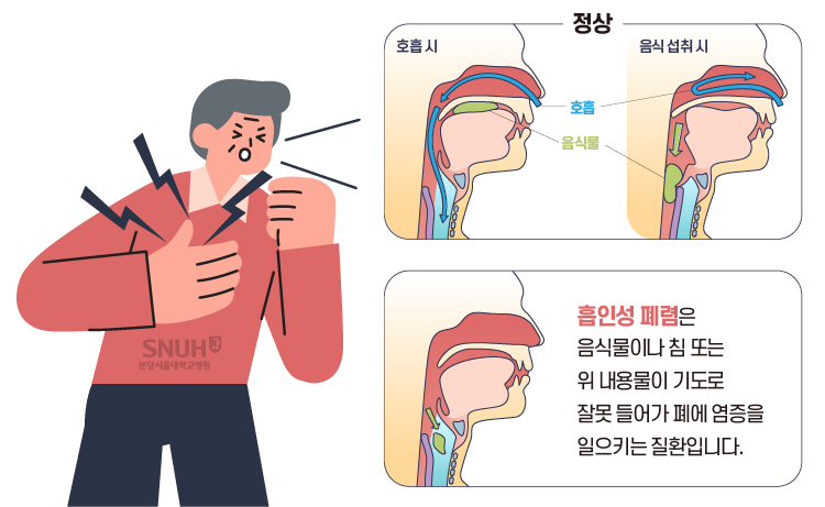 흡인성 폐렴 정의