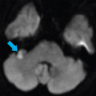 뇌졸중으로 인한 어지럼 환자의 MRI