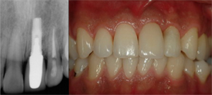 이가 한 개만 빠진 경우