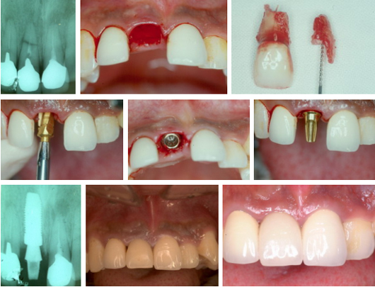 임플란트 치료는 어떤 과정을 거쳐 어떤 형태로 이루어지나요?