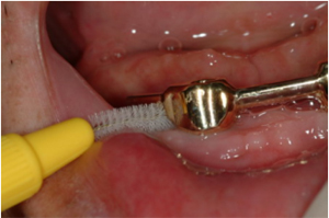 보철후 주의사항 및 유지관리