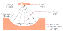 요로결석의 치료2