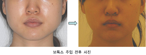 보톡스 주입 전후 사진