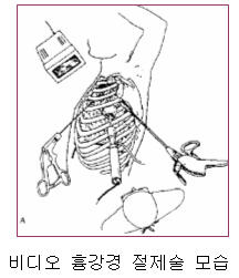 비디오 흉강경 절제술 모습