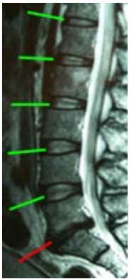 척추협착증(spinal stenosis)