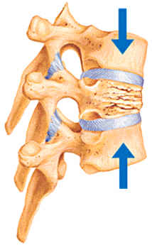 압박골절(compression fracture)이란?