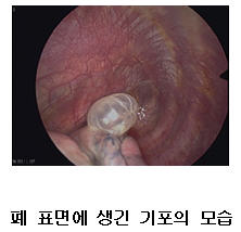 폐표면에 생긴 기포의 모습