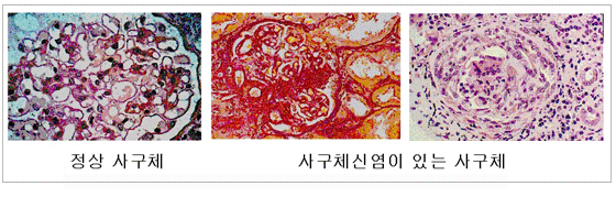 Disease_014_20050227200906_d_data_02.gif 정상 사구체,사구체신염이 있는 사구체