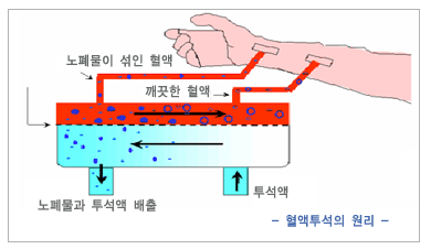열액투석의 장단점1