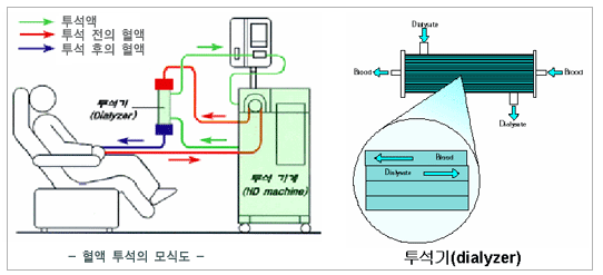 Disease_014_20050227201646_d_data_04.gif 열액투석의 장단점2