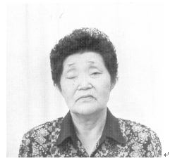 안검하수 증세를 보이는 중증근무력증 환자